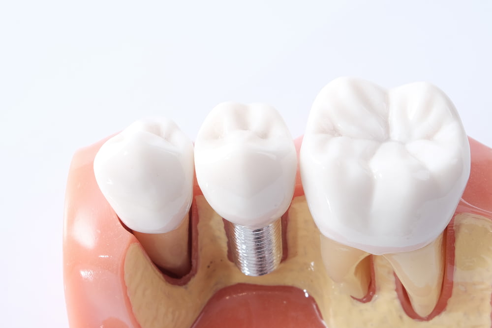Implantes Dentários: Quais os tipos e como funcionam? 2 Depositphotos 125386544 S