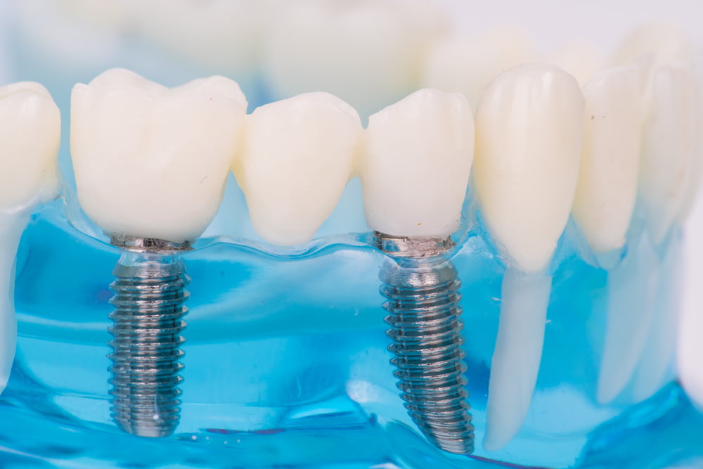 Implantes Dentários: Quais os tipos e como funcionam? 4 Depositphotos 287006802 S
