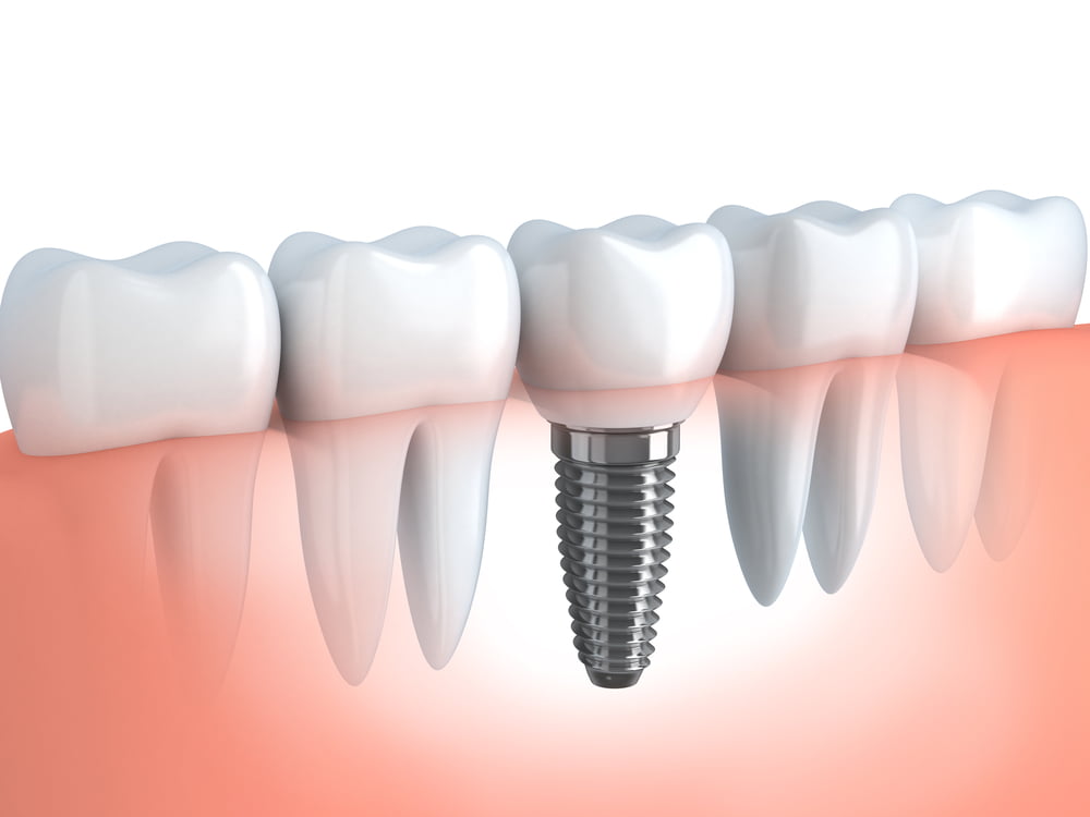 Implantes Dentários: Quais os tipos e como funcionam? 1 Implantes Dentários