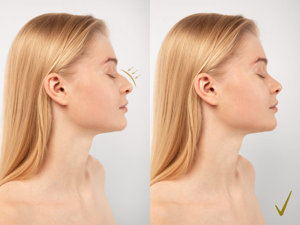 Quanto tempo dura a dor da rinoplastia? 2 rinoplastia antes depois